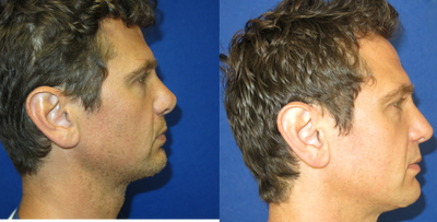 Revision Rhinoplasty before and after photo