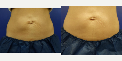 CoolSculpting before and after photo