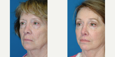 Facial Fat Transfer before and after photo