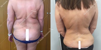 Liposuction before and after photo