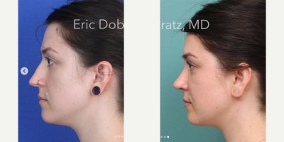 Septoplasty before and after photo