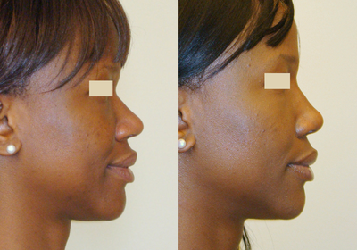 African American Rhinoplasty before and after photo
