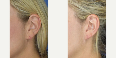 Earlobe Repair before and after photo