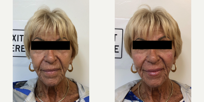 Lip Fillers before and after photo
