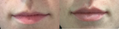Lip Lift before and after photo