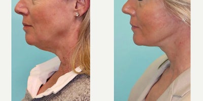 Neck Lift before and after photo
