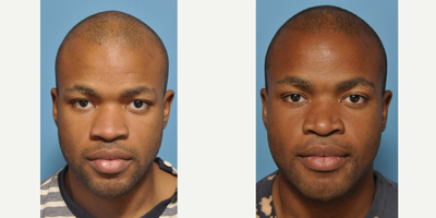 African American Rhinoplasty before and after photo