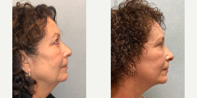 Facelift before and after photo