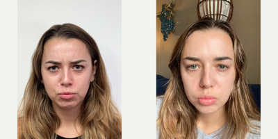 Xeomin before and after photo