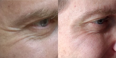 Botox before and after photo