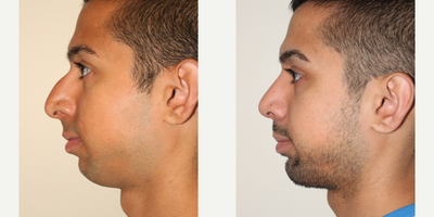 Rhinoplasty before and after photo