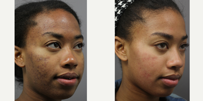 Cosmelan before and after photo