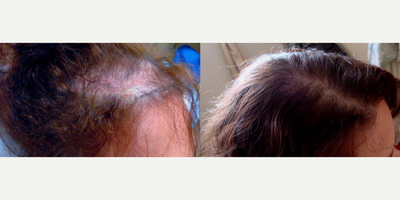 Hair Transplant before and after photo