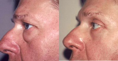 Eyelid Surgery before and after photo