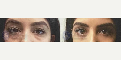 Eyelid Surgery before and after photo