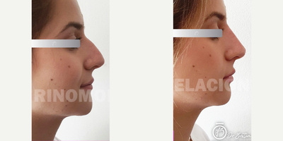 Nonsurgical Nose Job before and after photo