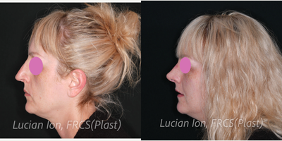 Revision Rhinoplasty before and after photo