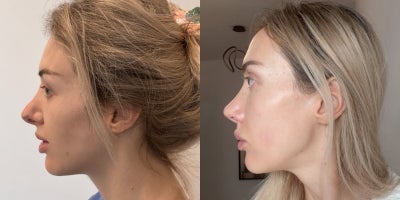 Revision Rhinoplasty before and after photo
