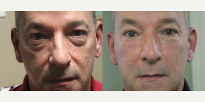 Botox before and after photo