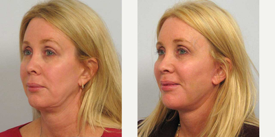 Facelift Revision before and after photo