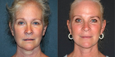 Facelift before and after photo
