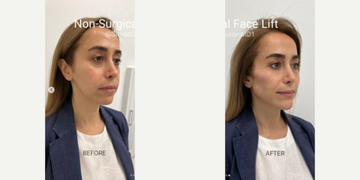 Secret RF before and after photo