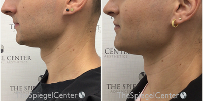 Adam's Apple Reduction before and after photo