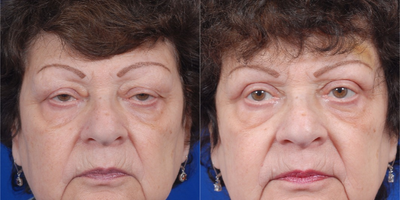Eyelid Surgery before and after photo