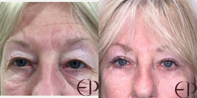Eyelid Surgery before and after photo