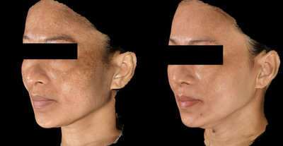 Laser Resurfacing before and after photo