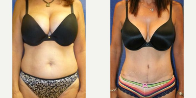 Liposuction before and after photo