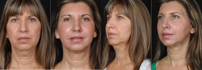 Nonsurgical Facelift before and after photo