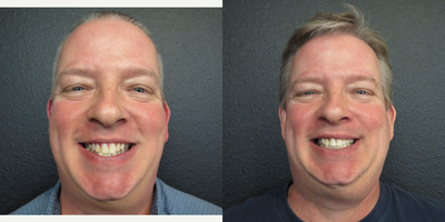 Smile Makeover before and after photo