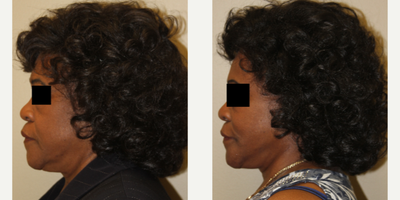 Facelift before and after photo