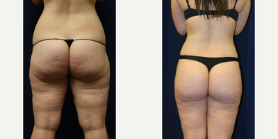 Liposuction before and after photo