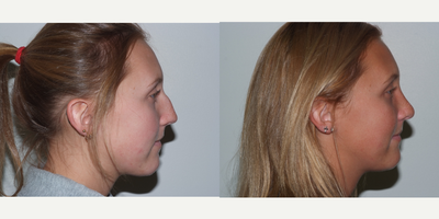 Rhinoplasty before and after photo