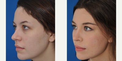 Rhinoplasty before and after photo