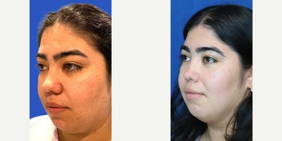 Rhinoplasty before and after photo