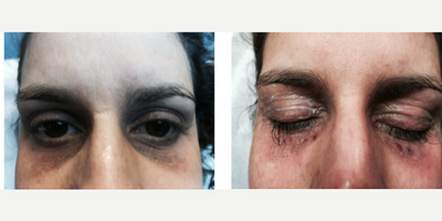 Sculptra before and after photo