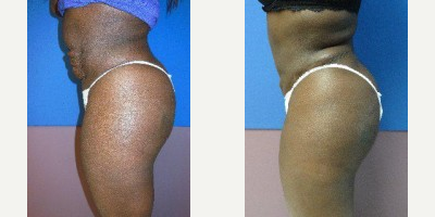 Tummy Tuck before and after photo