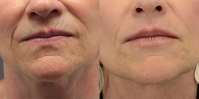 Ultherapy before and after photo