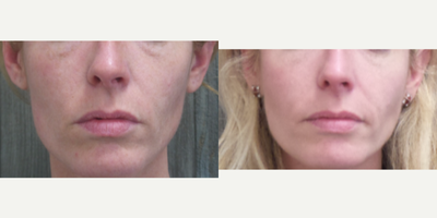IPL before and after photo