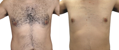 Laser Hair Removal before and after photo