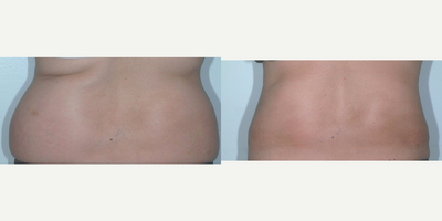 Liposuction before and after photo