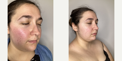 Skin Lightening before and after photo