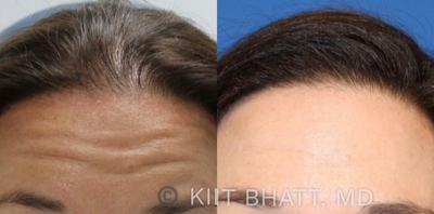 Botox before and after photo