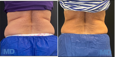CoolSculpting before and after photo
