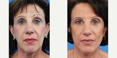Facelift before and after photo