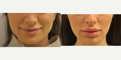 Juvederm before and after photo