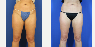 Liposuction before and after photo